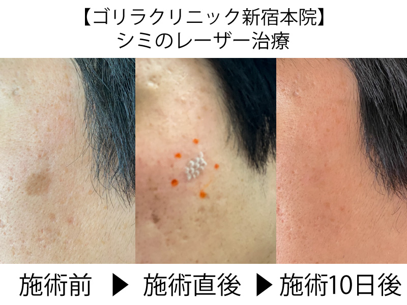 男の美容体験レポート 肌改善 ゴリラクリニック新宿本院 のシミレーザー治療がすごかった Daily Shinjuku